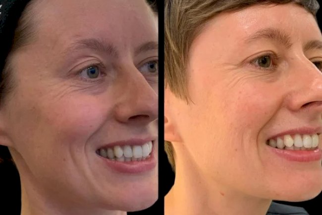 How the Best Doctors in Dubai Are Combining Profhilo with Other Treatments for Maximum Results