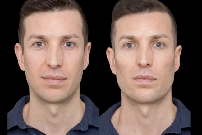 The Best Aesthetic Clinic in Dubai: Home to Top Cheek Filler Experts