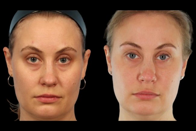 The Process of Under Eye Fillers at the Best Aesthetic Clinic in Dubai