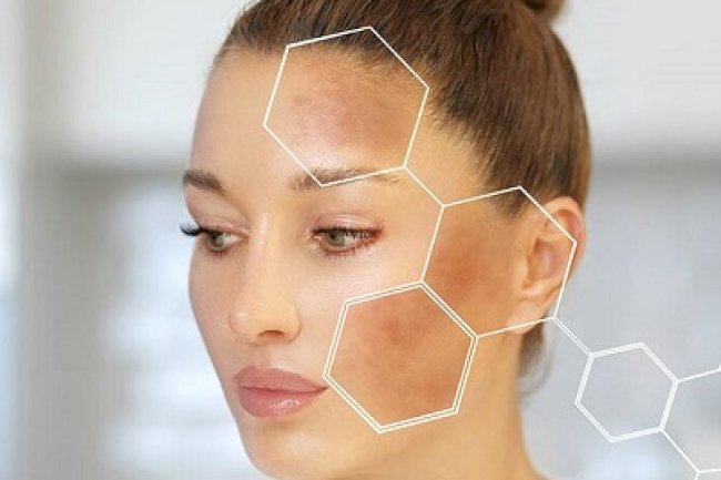 Pros and Cons of Natural vs Medical Melasma Treatments in Islamabad