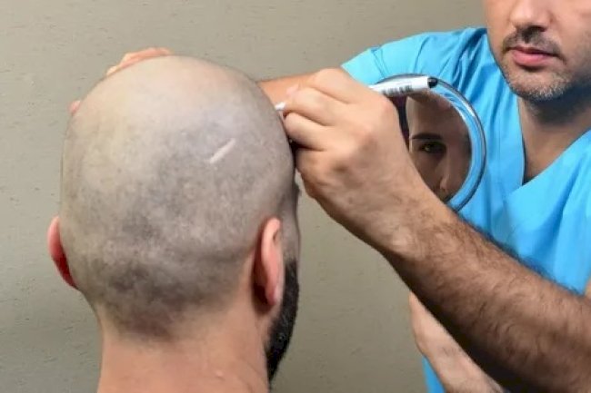 Hair Transplant in Dubai 2025: Your Comprehensive Guide to Modern Hair Restoration
