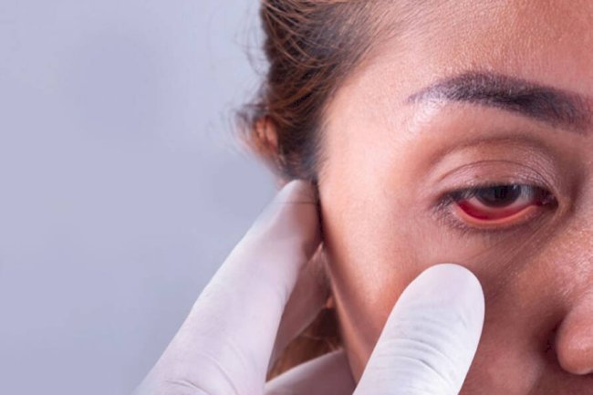 Natural Ayurvedic Solutions for Managing Glaucoma Without Surgery