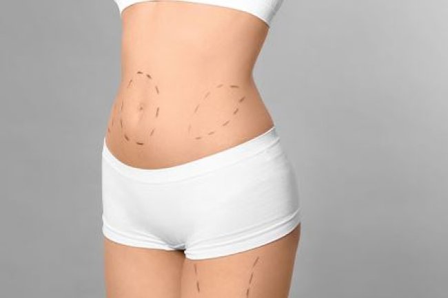 Under the Knife, Over the Top: Liposuction in the Limelight