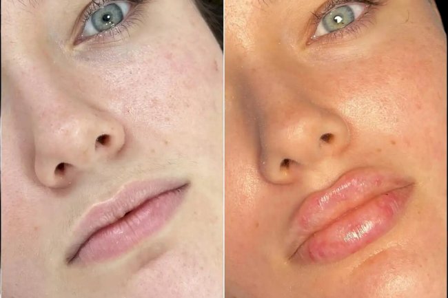 Sculpt Your Face with Fillers Treatment in Dubai