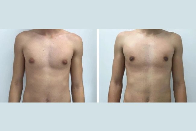 Gynecomastia in Dubai: What to Expect Before and After