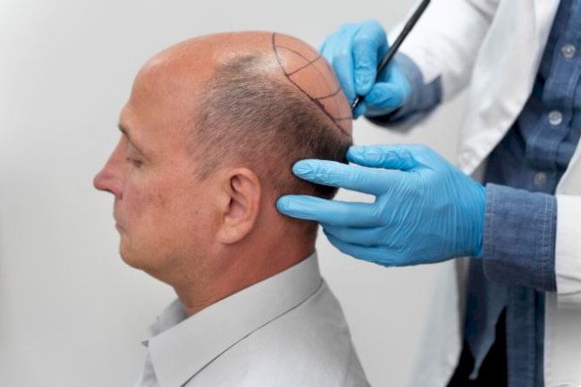 Hair Transplant Procedure for Hair Loss Treatment in Men