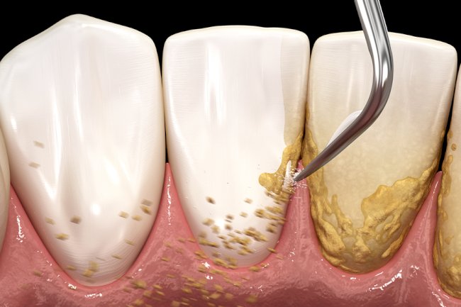 Scaling of Teeth What It Is, Why It’s Important, and How It Improves Your Oral Health