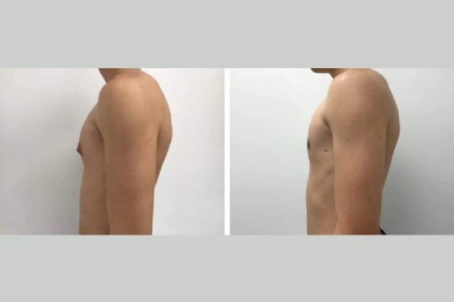 The Best Gynecomastia Surgeons in Dubai for Natural-Looking Results