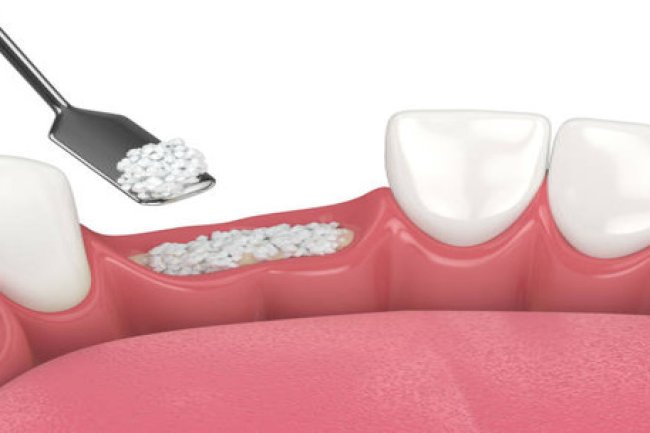 What Is Dental Bone Grafting? A Simple Explanation for Patients