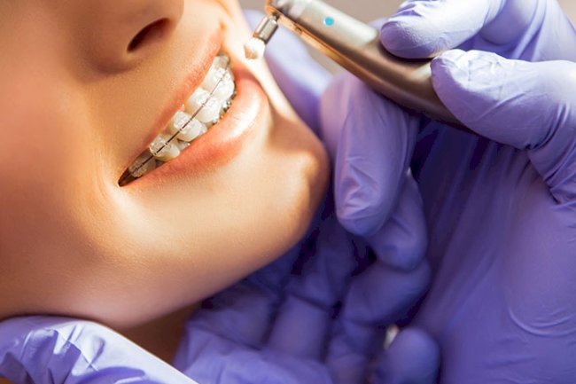 Discover Your Best Smile with Braces or Invisalign at Orb Dental in Brampton