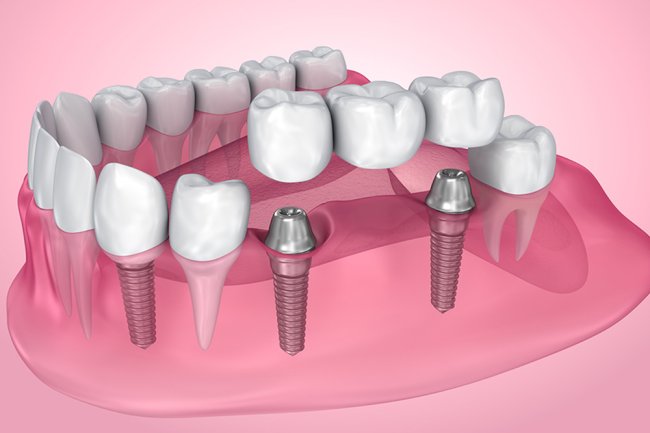 Reclaim Your Confident Smile with Dental Bridges in York: What You Need to Know