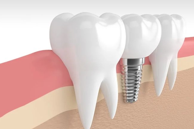 Sparkle with Every Smile Using Dental Implants in Dubai