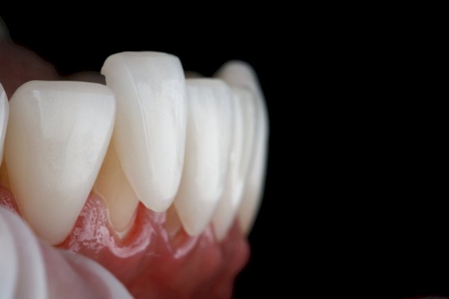 The Role of Dental Veneers in Cosmetic Dentistry: Trends and Innovations