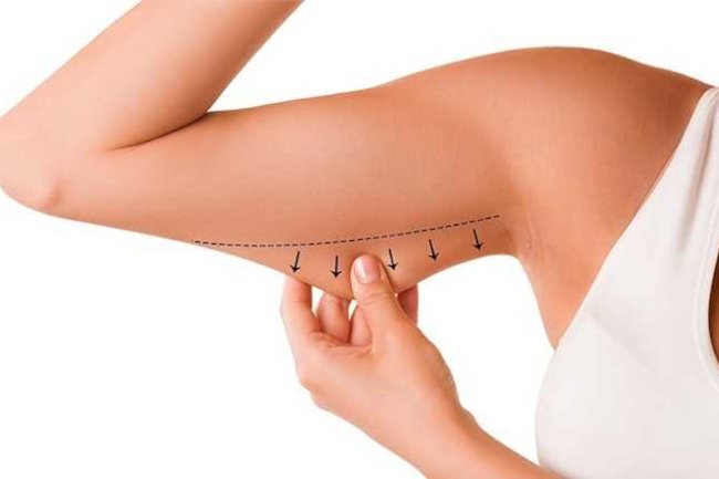 شرح جراحة شد الذراعين: الفوائد، المخاطر، وفترة النقاهة