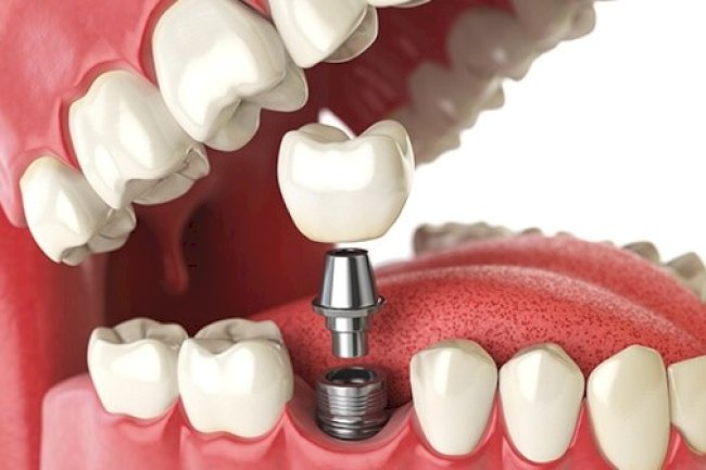 A Breakdown of Single vs. Full Mouth Dental Implants Cost in Dubai