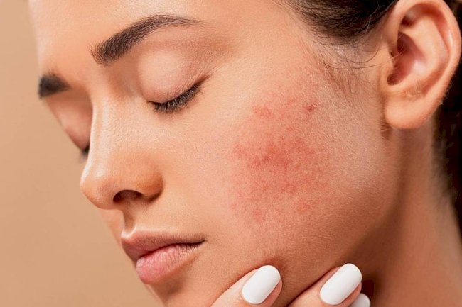 What is the Most Effective Treatment for Acne?