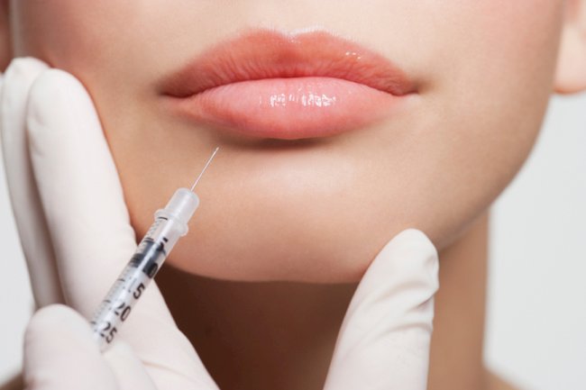 Are Lip Fillers Permanent?