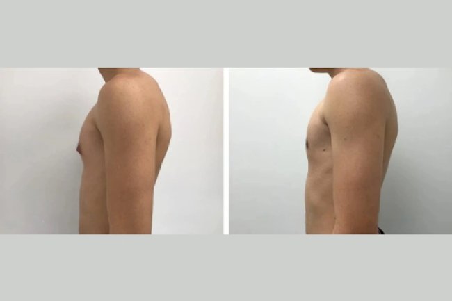 Male Boob Surgery in Dubai: Understanding the Benefits of Gynecomastia Surgery