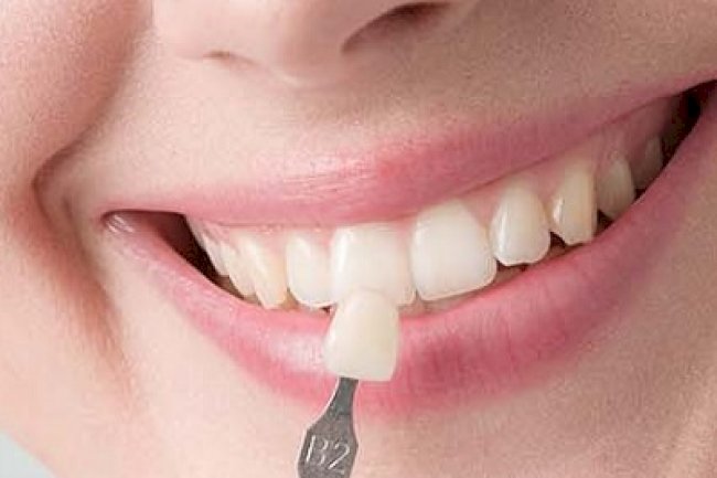 Is There Pain During or After Composite Veneers?