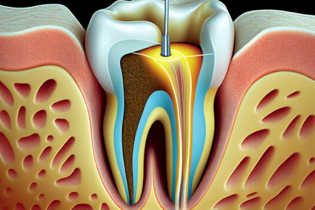 Aesthetic Crown Options After Root Canal in Islamabad