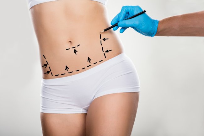 The Future of Liposuction: Trends to Watch in 2025 and Beyond