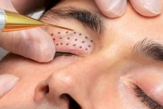 What Areas Can Be Treated with Plasma Pen?