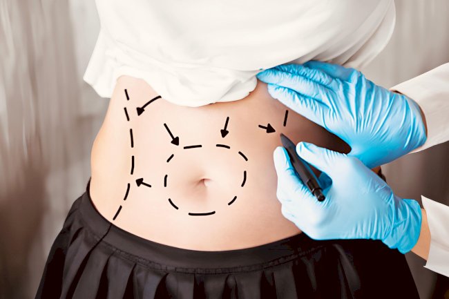 Bariatric Surgery Safety: What Patients Must Know Today