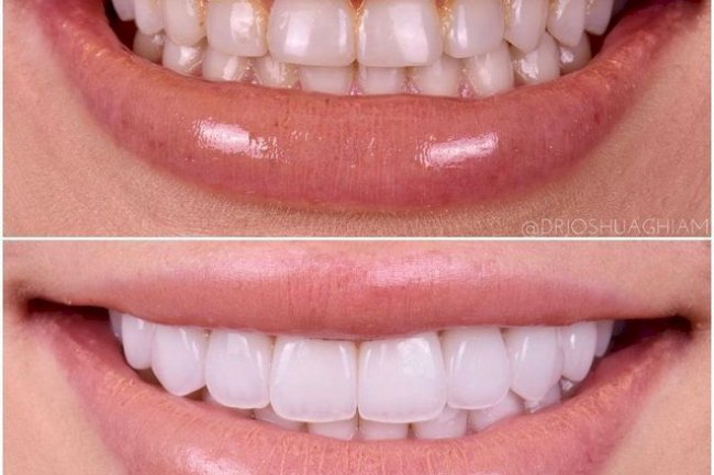 Dental Implants in Sacramento: A Complete Guide to Restoring Your Smile