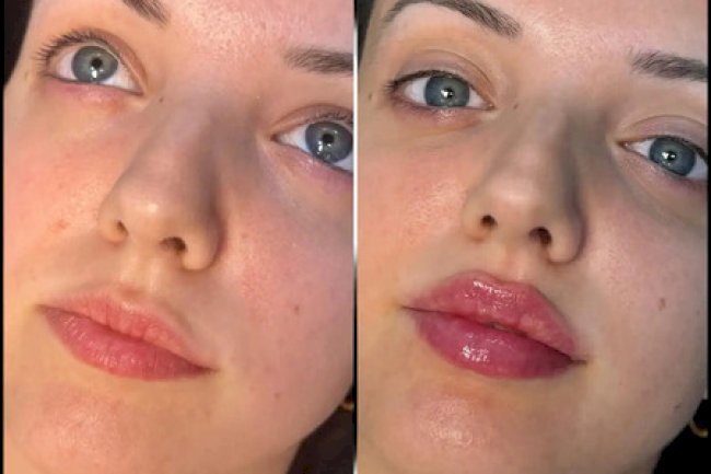 Innovative Fillers Techniques at the Best Aesthetic Clinic in dubai