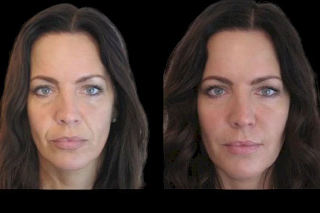 The Best Aesthetic Clinics in Dubai for Perfect Jawline Sculpting