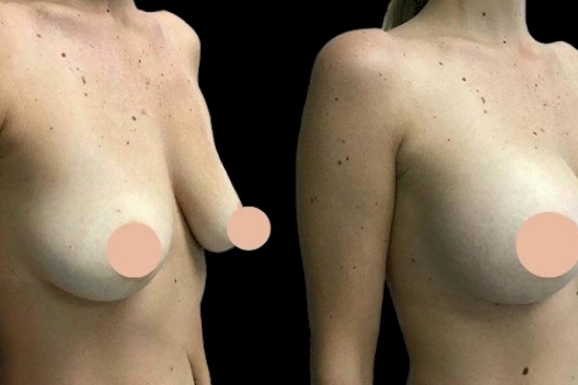 Natural-Looking Breast Enhancements by the Best Breast Augmentation Surgeons in Dubai