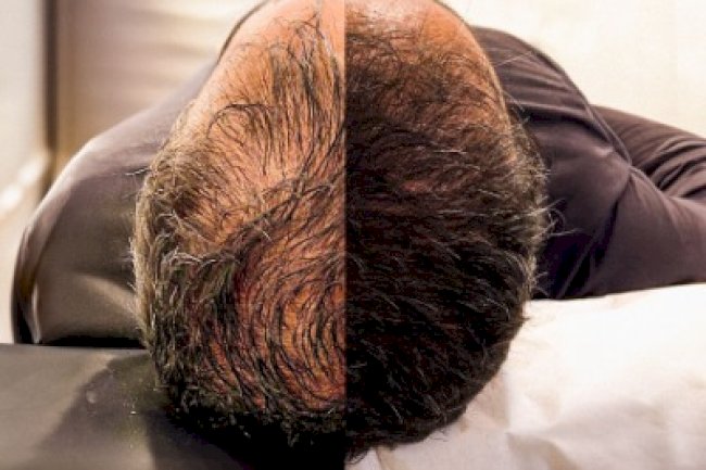 Does Hair Transplantation Work for Everyone in Islamabad?