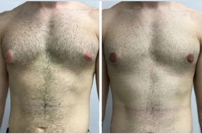 Post-Op Care Tips from the Best Gynecomastia Surgeon in Dubai
