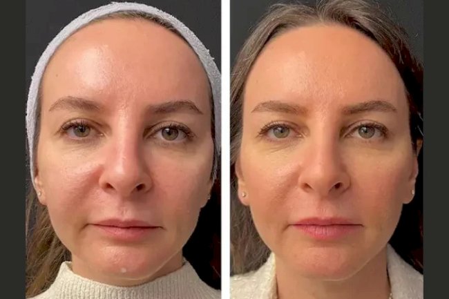 How the Best Aesthetic Clinics in Dubai Customize Mesotherapy for Every Skin Type