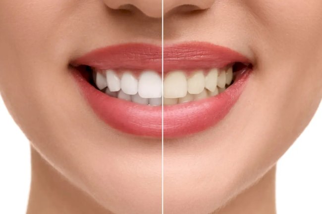 What Tiny Habits Drive Up Teeth Whitening Cost?