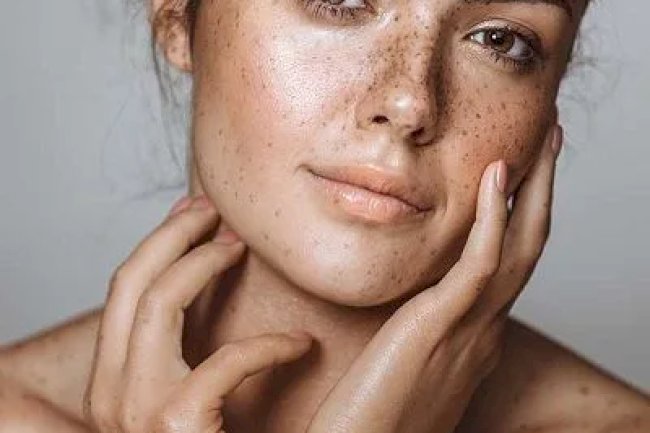 Are Natural Melasma Treatments Really Effective Long-Term?