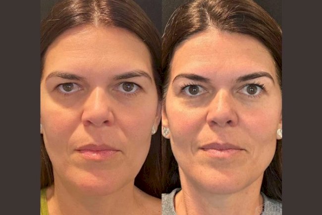 Recovery Tips After a Thread Lift from the Best Plastic Surgeon in Dubai