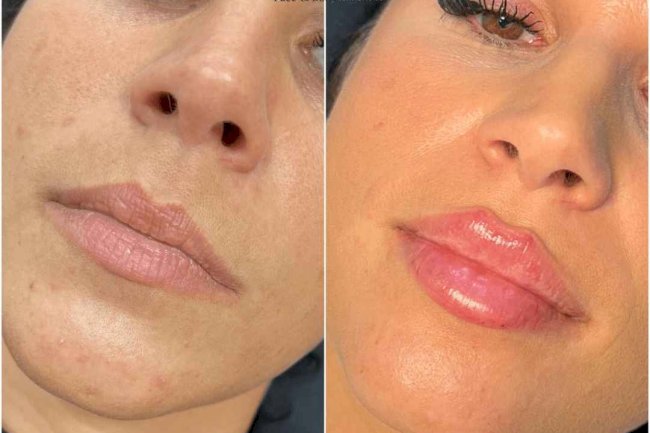 The Secret to Youthful Skin with Juvederm: A Step-by-Step Guide from the Best Plastic Surgeon in Dubai