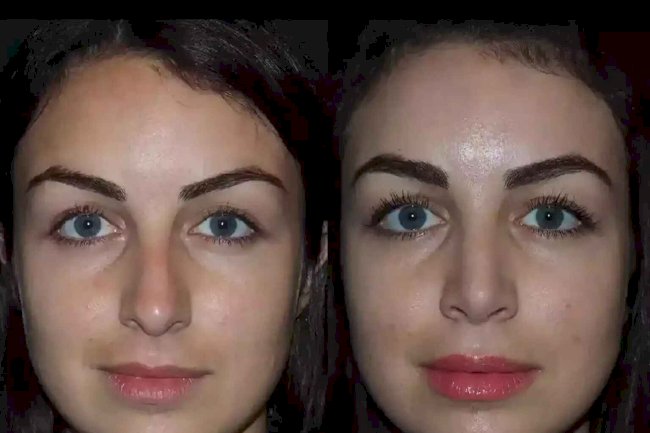 How Best Septoplasty Surgeons in Dubai Are Redefining Nasal Health