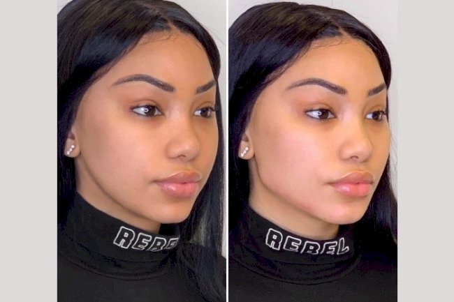 Comparing Facelift vs. Thread Lift Treatment in Dubai