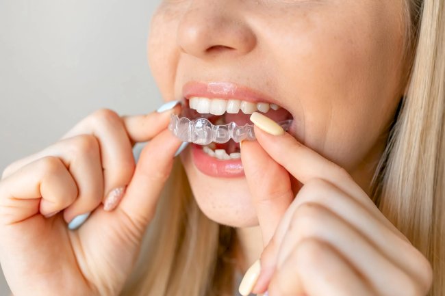 Invisalign Braces Treatment: Tracking Progress Effectively
