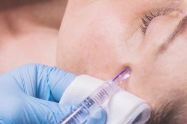 How Long Does Mesotherapy Last? A Complete Guide