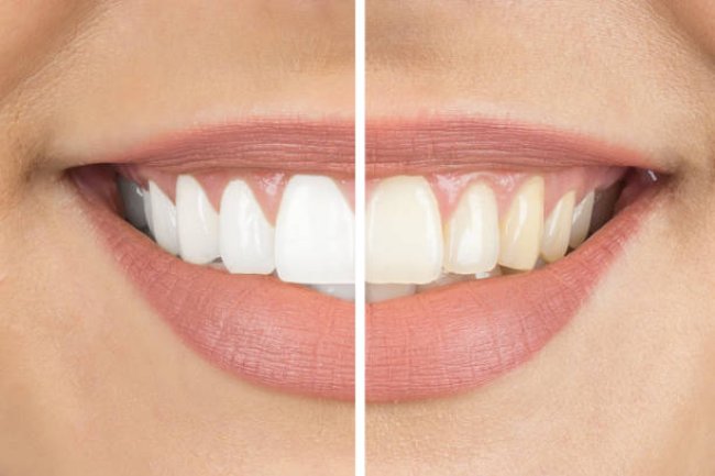 Is Teeth Whitening Cost Higher for Sensitive Teeth Cases?