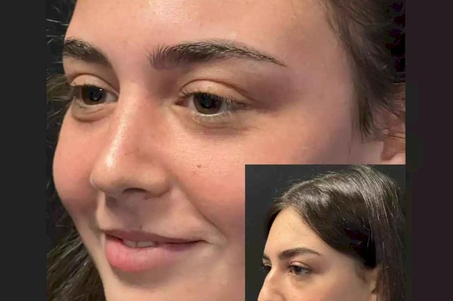 What Results Can the Best Septoplasty Surgeons in Dubai Deliver?