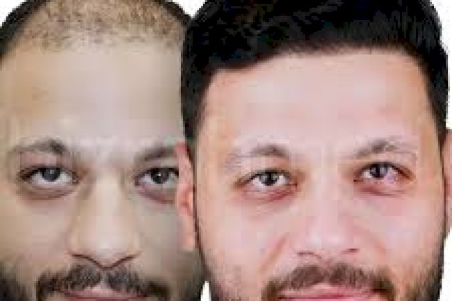 ما الذي يحدد تكلفة زراعة الشعر في الرياض؟