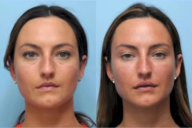 Achieve Flawless Contours Using Thread Lift Provided by the Best Doctors in Dubai