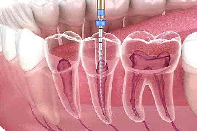 How Long Does It Take to Heal After Root Canal Treatment?