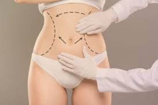 Tummy Tuck for Stretch Marks Reduction in Islamabad