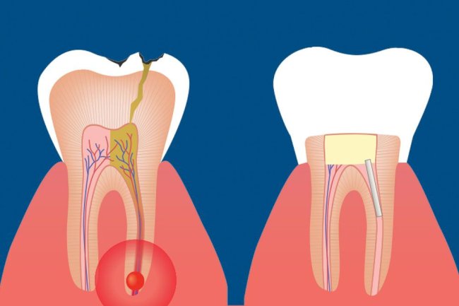Can a Root Canal Treatment Prevent Future Tooth Pain?