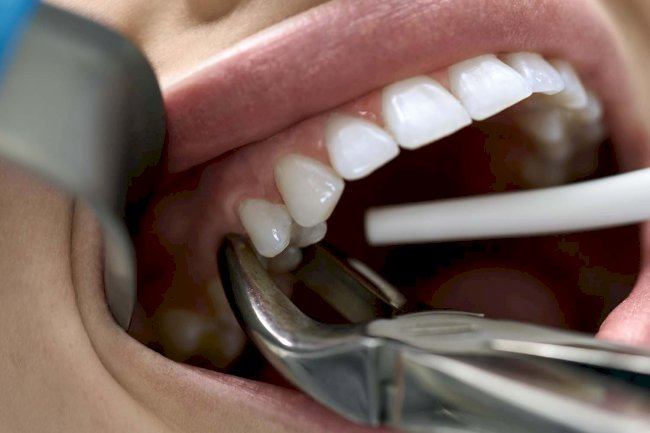 Are Tooth Extractions Cheaper Than Root Canals?